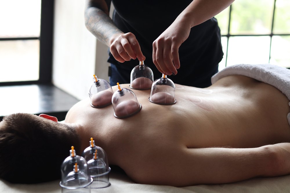 Cupping Therapy