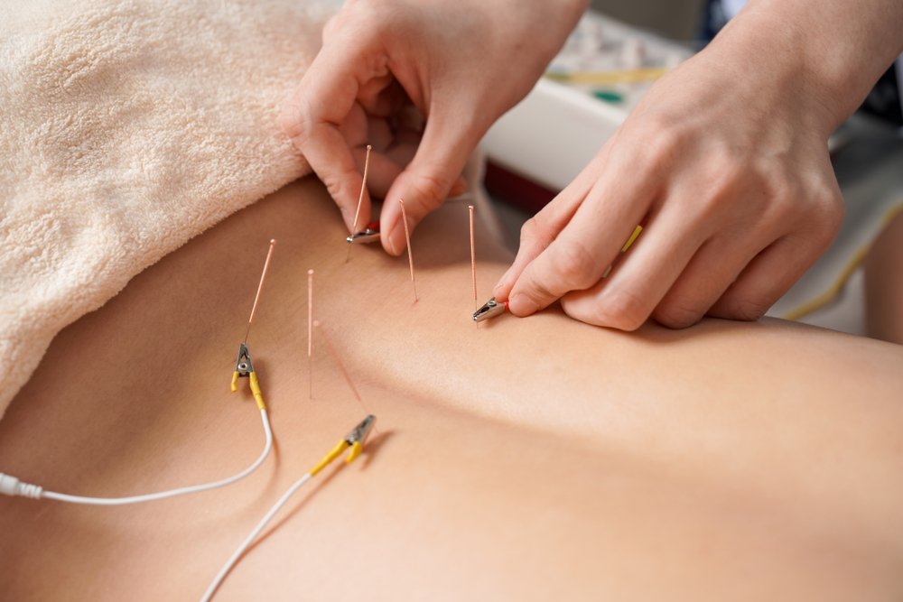 Electroacupuncture