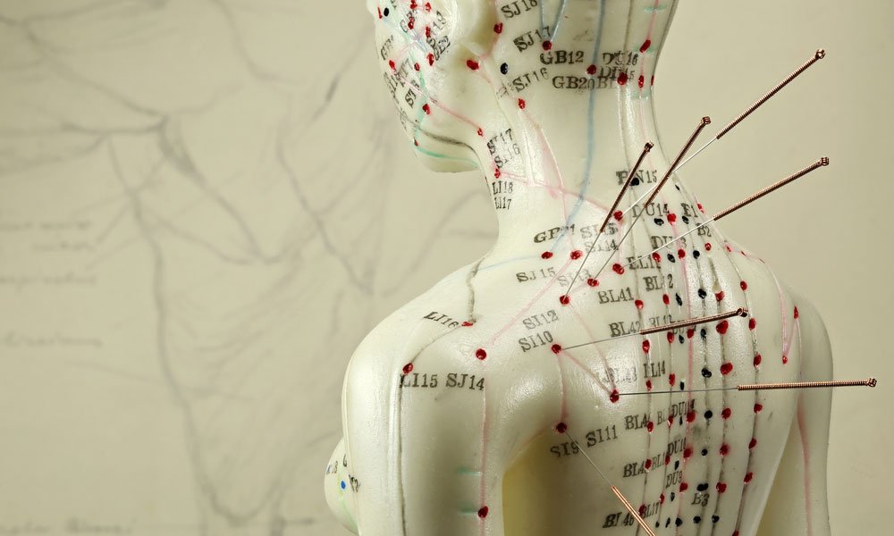 Acupuncture in Melbourne