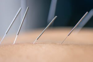 Melbourne Acupuncture